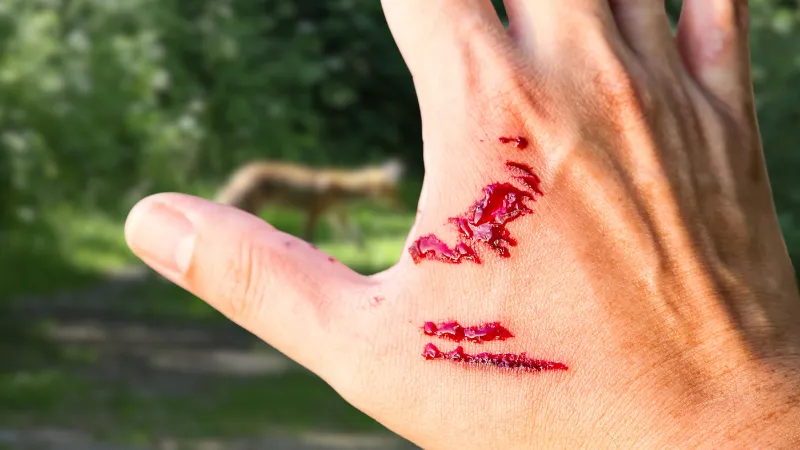 A dog bite wound and blood on hand. Infection and Rabies concept. Sarting of Rabies